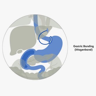 Darstellung der Organe im Körper mit Fokus auf das Magenband (Gastric Banding). Links sind die Organe in neutralen Farben, rechts die Darstellung des Magenbands in blauen Tönen.