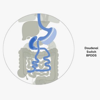 Darstellung der Organe im Körper mit Fokus auf den Dünndarm. Links ist Variante 1 (Druck) und rechts Variante 2 (Bildschirm) abgebildet, beide zeigen das Malabsorptionsverfahren.