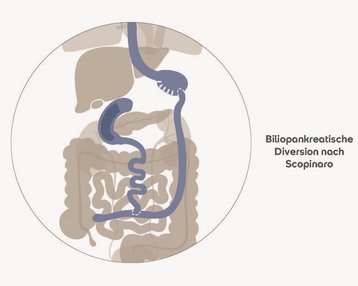 Biliopancreatische Diversion nach Scopinaro, schematische Darstellung des Verdauungssystems mit hervorgehobenen anatomischen Strukturen.