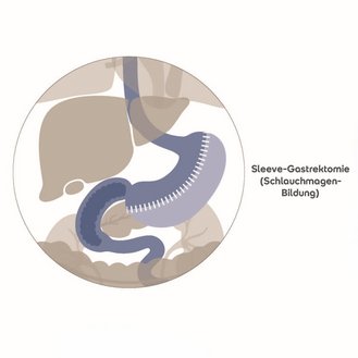 Darstellung der Organe im Körper mit Fokus auf die Sleeve-Gastrektomie und eine alternative Variante. Die Abbildung zeigt schematische Darstellungen der Magenoperationen.