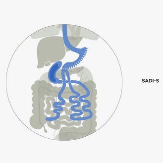 Darstellung der Organe im Körper, mit zwei Varianten: eine für den Druck und eine für den Bildschirm, beide zeigen malabsorptive Verfahren.