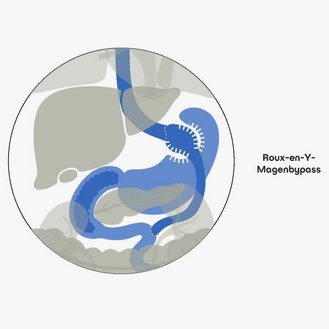 Darstellung von Organen im Körper mit zwei Varianten: links für Druck und rechts für Bildschirm, einschließlich des Roux-en-Y-Magenbypasses. Grafische Darstellung in unterschiedlichen Farbtönen.