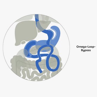 Darstellung des Omega-Loop-Bypasses in zwei Varianten: eine für den Druck und eine für den Bildschirm, mit schematischen Darstellungen der Organe im Körper und den malabsorptiven Verfahren.